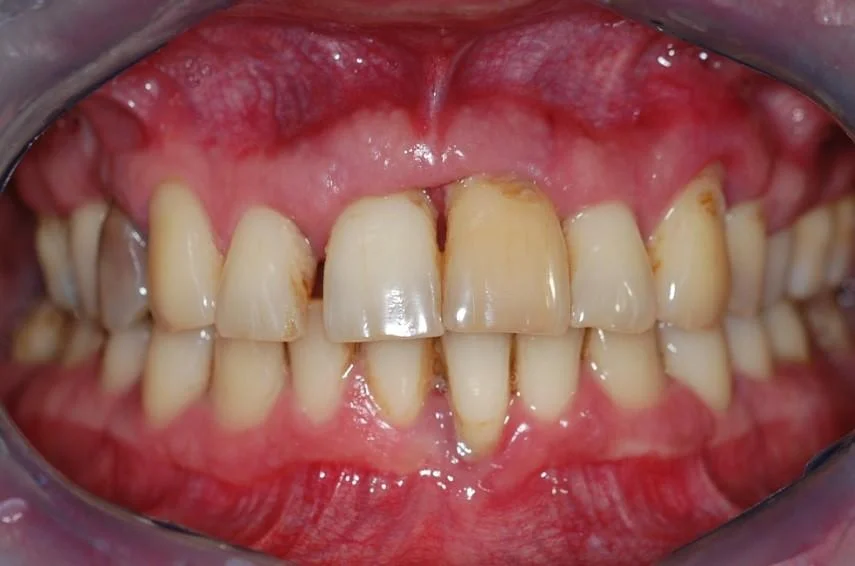 A parodontitis a 2-es típusú diabétesz alábecsült rizikófaktora