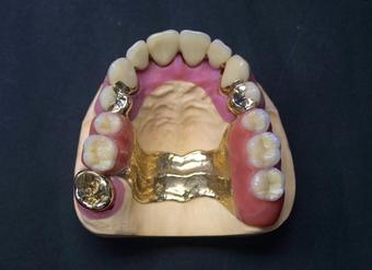 Drei verschiedene Arten des Zahnersatzes können angefertigt werden.
